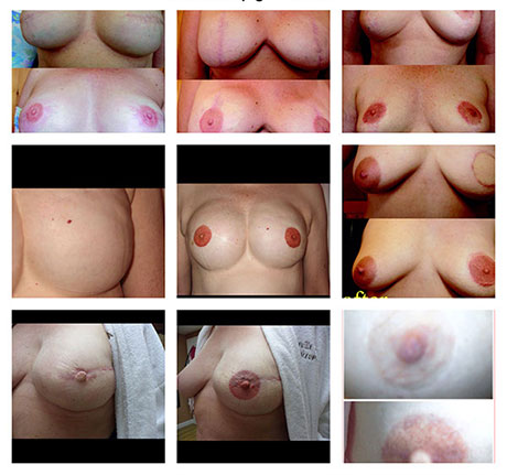 Areola Pigmentation for Breast Cancer Survivors - Ohio